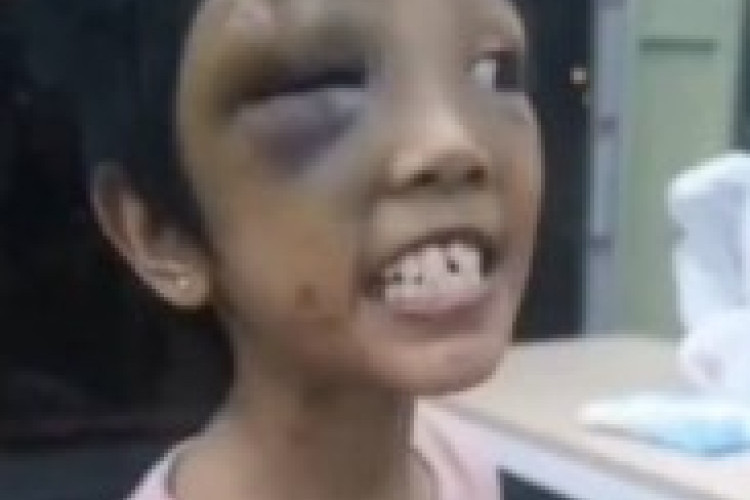 Sadis! Ibu Angkat dan Ayah Kandung Siksa Anak Berusia 9 Tahun di Batam, Korban Alami Luka Bakar Rokok