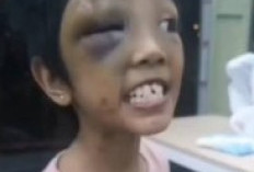 Sadis! Ibu Angkat dan Ayah Kandung Siksa Anak Berusia 9 Tahun di Batam, Korban Alami Luka Bakar Rokok